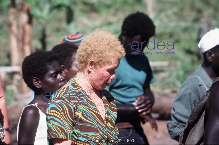 : Albino Bougainville Woman : Albino Bougainville Woman