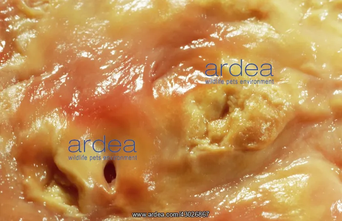 : Atherosclerotic Plaque and Obstructed Lumen of Human Aorta : Atherosclerotic Plaque and Obstructed Lumen of Human Aorta