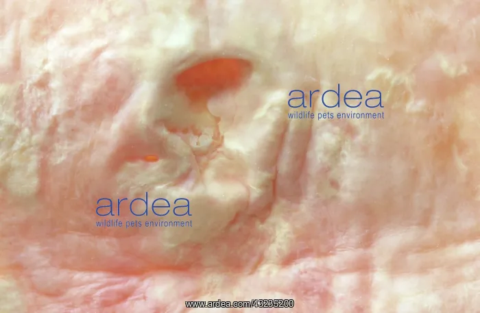 : Atherosclerotic Plaque and Obstructed Lumen of Human Aorta : Atherosclerotic Plaque and Obstructed Lumen of Human Aorta