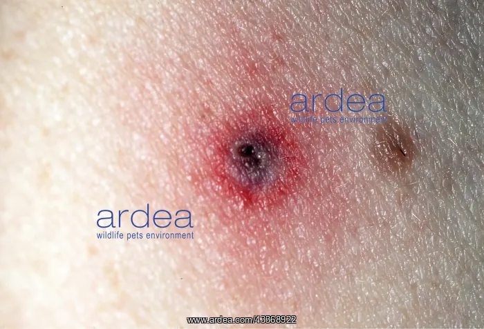 : Black-legged Tick Bite : Black-legged Tick Bite