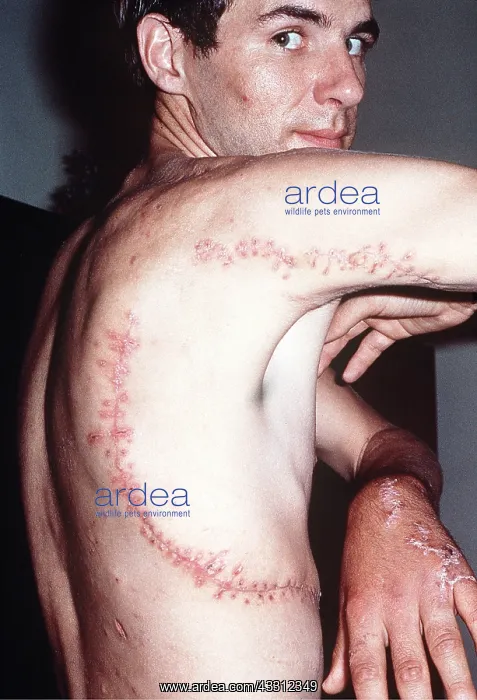 : DIVER - Shark attack victim - Rod / Rodney Fox showing : DIVER - Shark attack victim - Rod / Rodney Fox showing