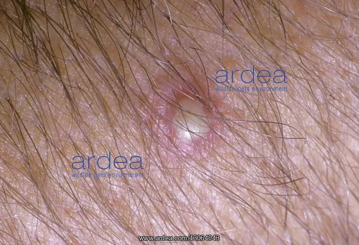 : Fire Ant sting : Fire Ant sting