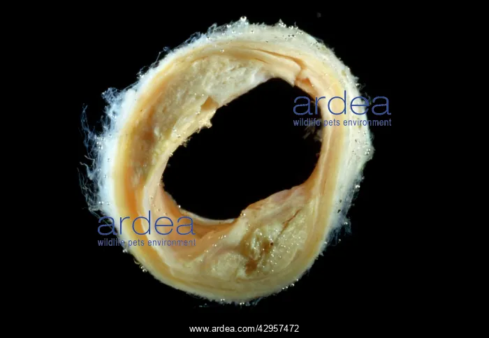 : Light Micrograph of Atherosclerotic Plaque and : Light Micrograph of Atherosclerotic Plaque and