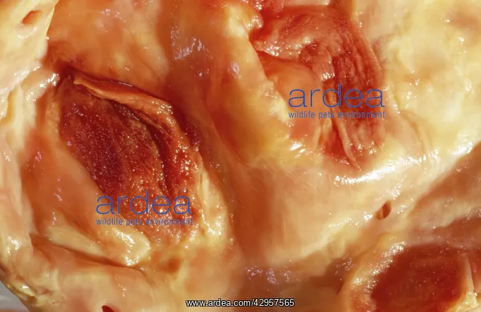 : Light Micrograph of Atherosclerotic Plaque and : Light Micrograph of Atherosclerotic Plaque and