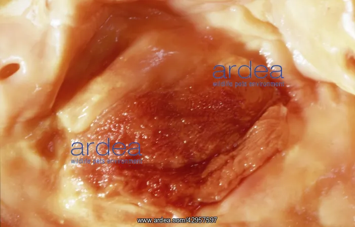: Light Micrograph of Atherosclerotic Plaque and : Light Micrograph of Atherosclerotic Plaque and