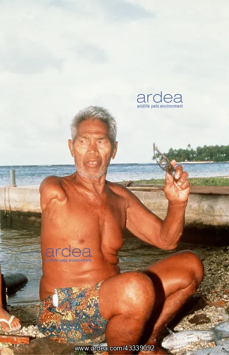 : Shark attack victim - arm removed by shark : Shark attack victim - arm removed by shark