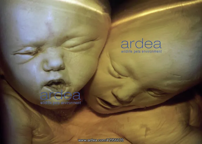 : Siamese Twins joined at the head : Siamese Twins joined at the head