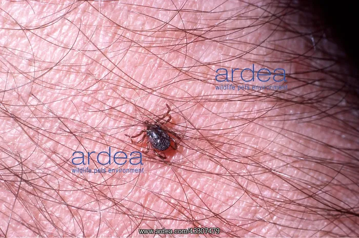 : TICK on human skin - Close-up : TICK on human skin - Close-up