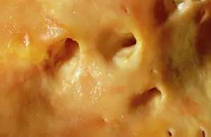 Micro: Atherosclerotic Aorta Vessel