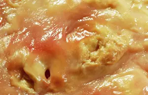 Plaque: Atherosclerotic Plaque and Obstructed Lumen of Human Aorta