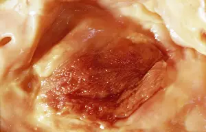 Plaque: Atherosclerotic Plaque and Obstructed Lumen of Human Aorta