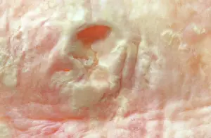 Micro: Atherosclerotic Plaque and Obstructed Lumen of Human Aorta