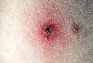 Ticks: Black-legged Tick Bite