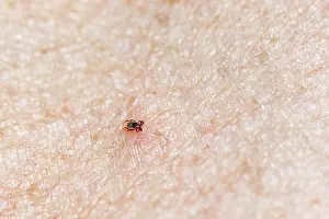 Tick: Castor Bean Tick (Ixodes ricinus), tick on human