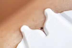 Tick: Castor Bean Tick (Ixodes ricinus), tick on human