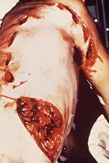 Attacks: Diver - Rodney Fox on operation table showing Shark