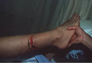Attack: DIVER WITH SHARK BITE ON LEG