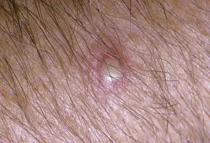 Sting: Fire Ant sting