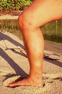 Sting: Jellyfish Sting - Blistering on manIs leg