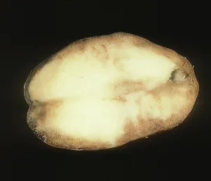 Tuberosum: Late blight of Potato