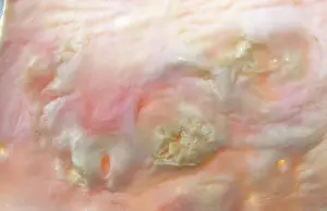 Plaque: Light Micrograph of Atherosclerotic Plaque and