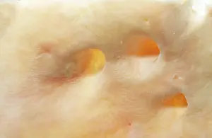 Plaque: Light Micrograph of Atherosclerotic Plaque and