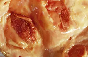 Plaque: Light Micrograph of Atherosclerotic Plaque and