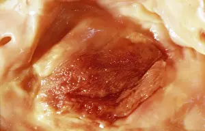 Plaque: Light Micrograph of Atherosclerotic Plaque and
