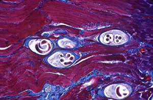 Worms: ROUND WORM - Larval cysts of trichinells spiralis in muscle