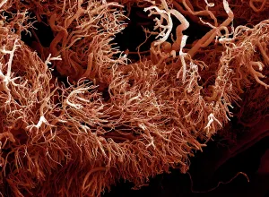 Corrosion: Scanning Electron Micrograph (SEM): a corrosion