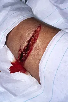 Attack: Shark attack victim - bite on leg wound (Valerie