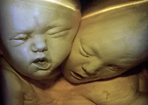 Mutations: Siamese Twins joined at the head